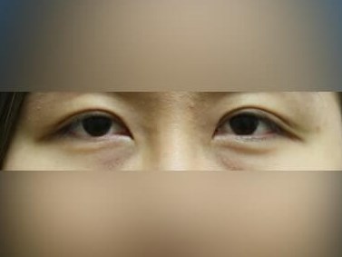 Asian Eyelid After