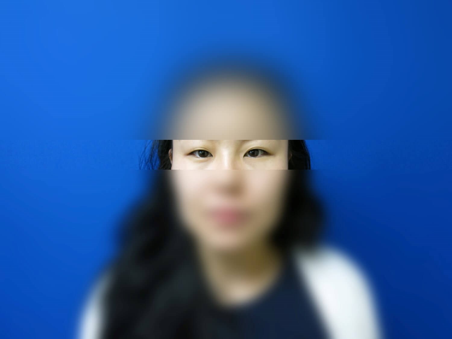 Asian Eyelid Before