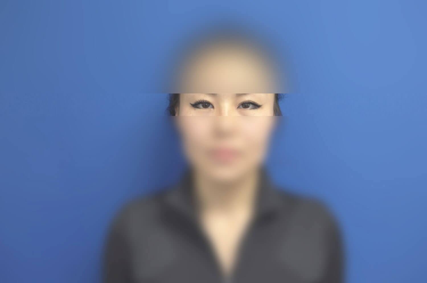 Asian Eyelid After