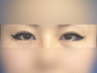 Asian Eyelid After