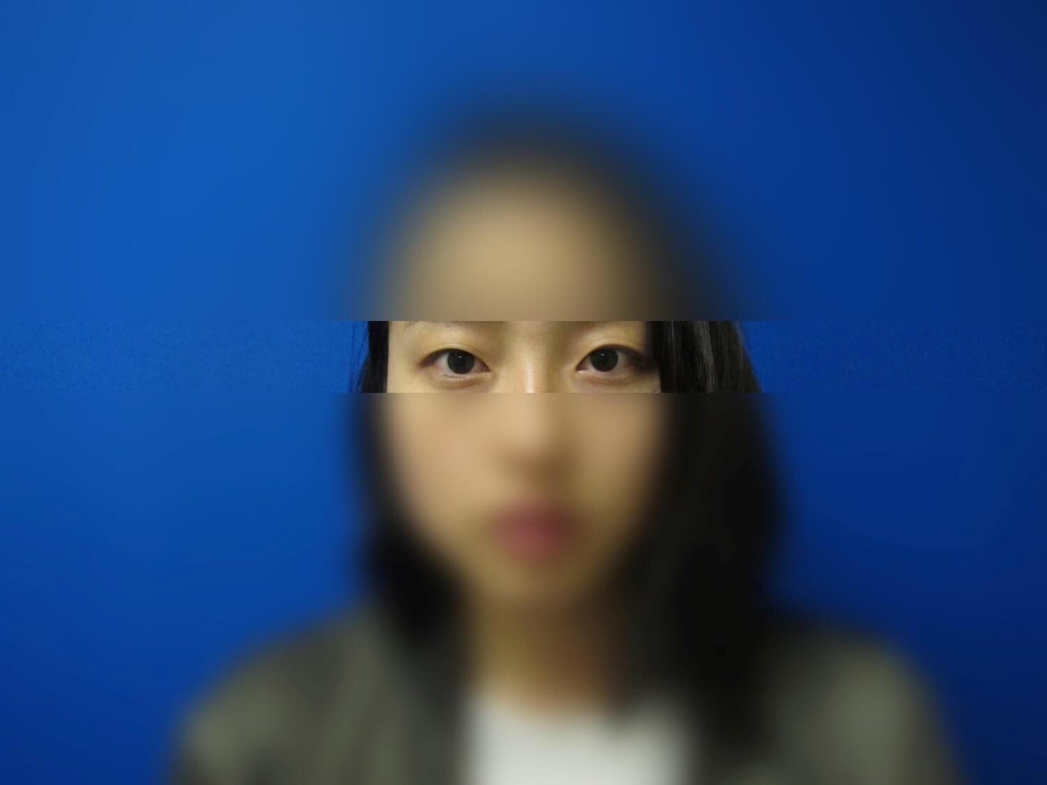 Asian Eyelid Before