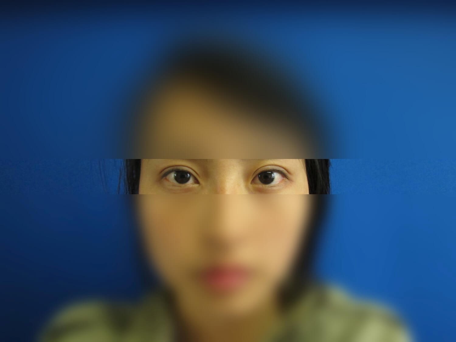 Asian Eyelid After