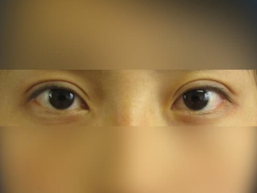 Asian Eyelid After
