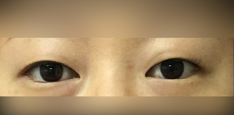 Asian Eyelid Before