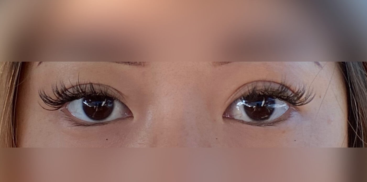 Asian Eyelid After