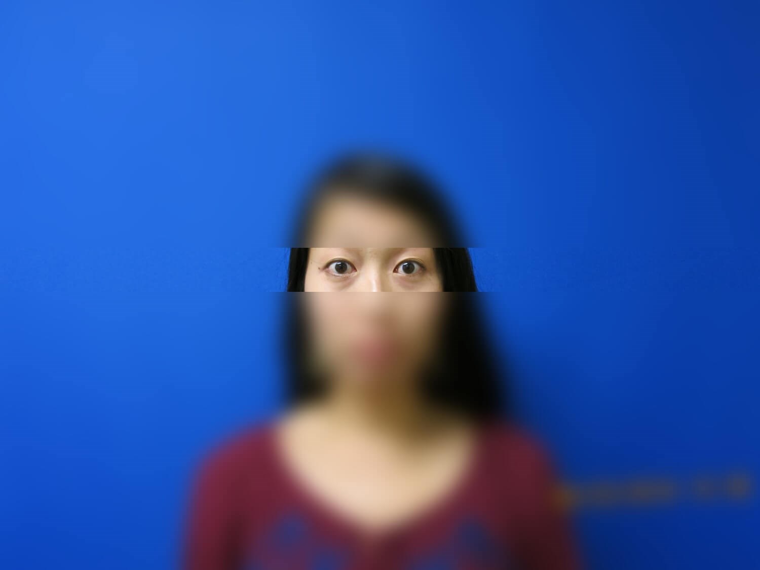 Asian Eyelid Before
