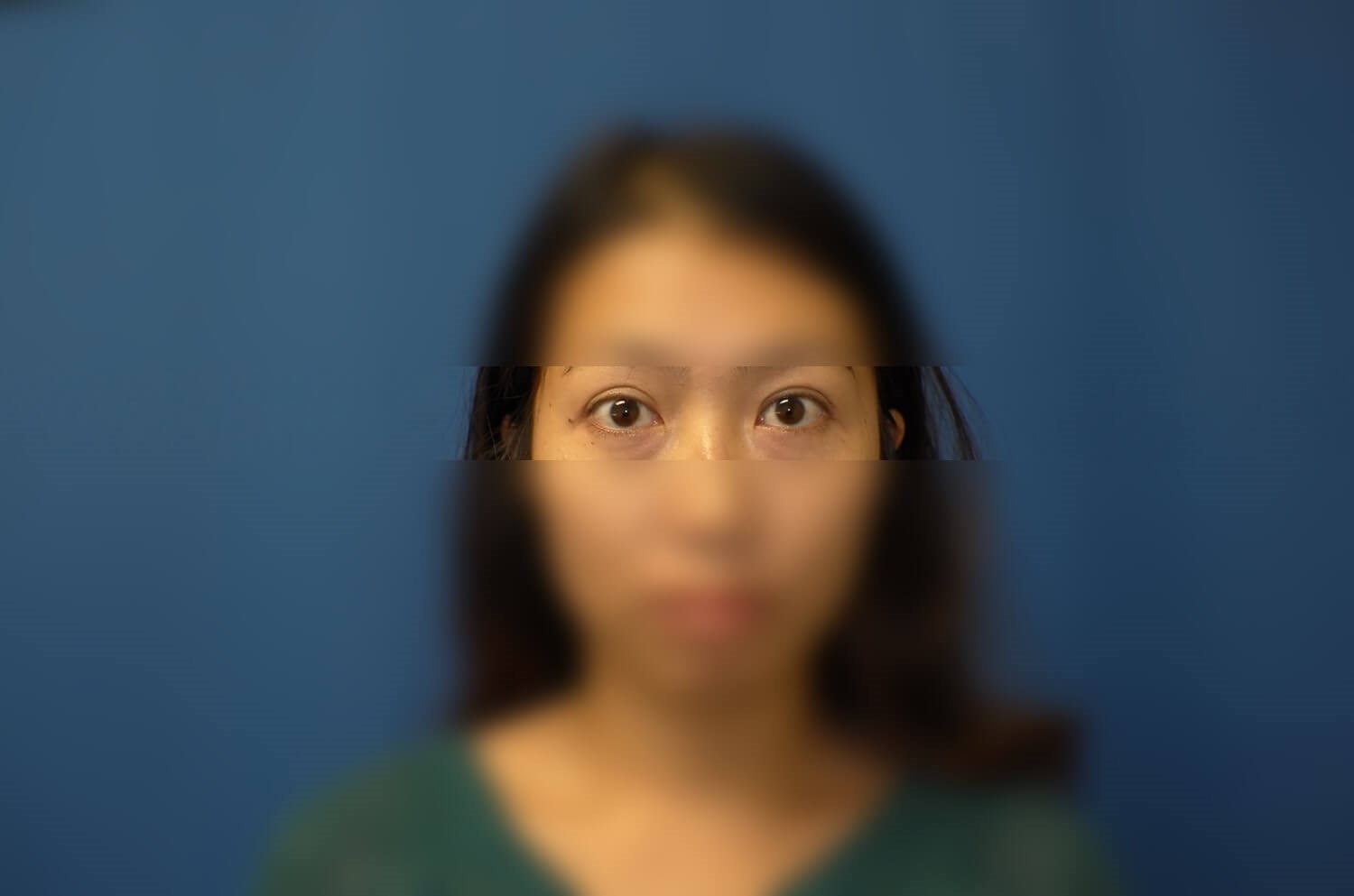 Asian Eyelid After