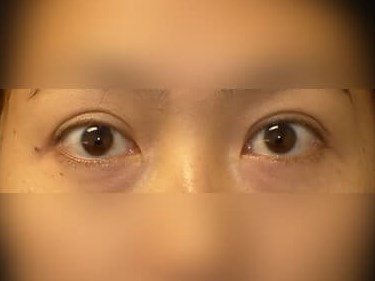 Asian Eyelid After
