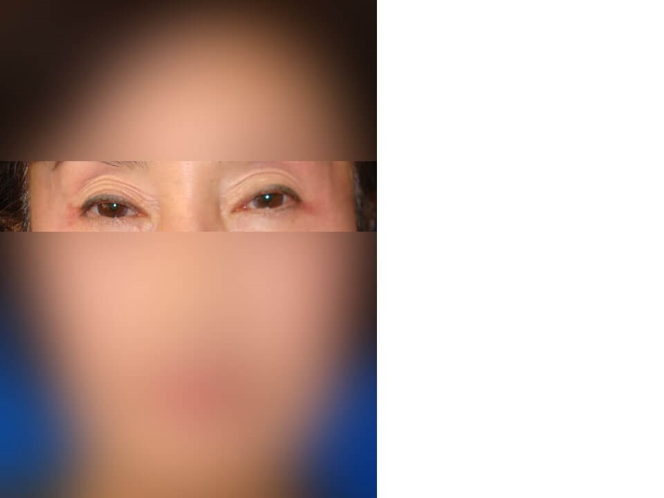 Upper Eyelid Surgery After