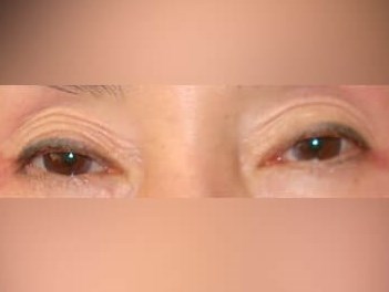 Upper Eyelid Surgery After