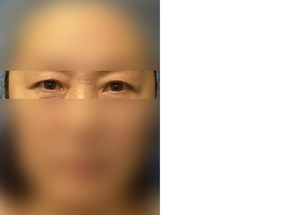 Upper Eyelid Surgery Before