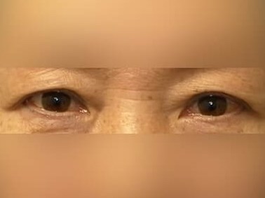 Upper Eyelid Surgery Before
