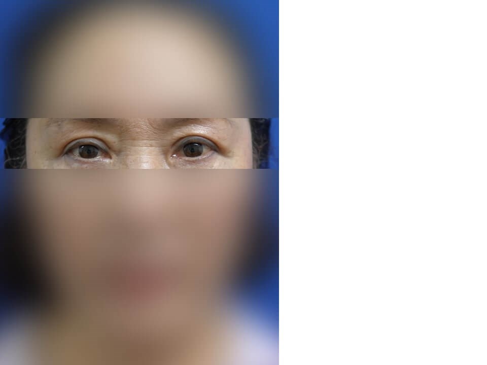 Upper Eyelid Surgery After