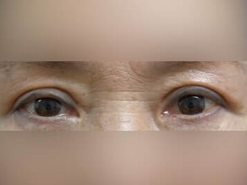 Upper Eyelid Surgery After