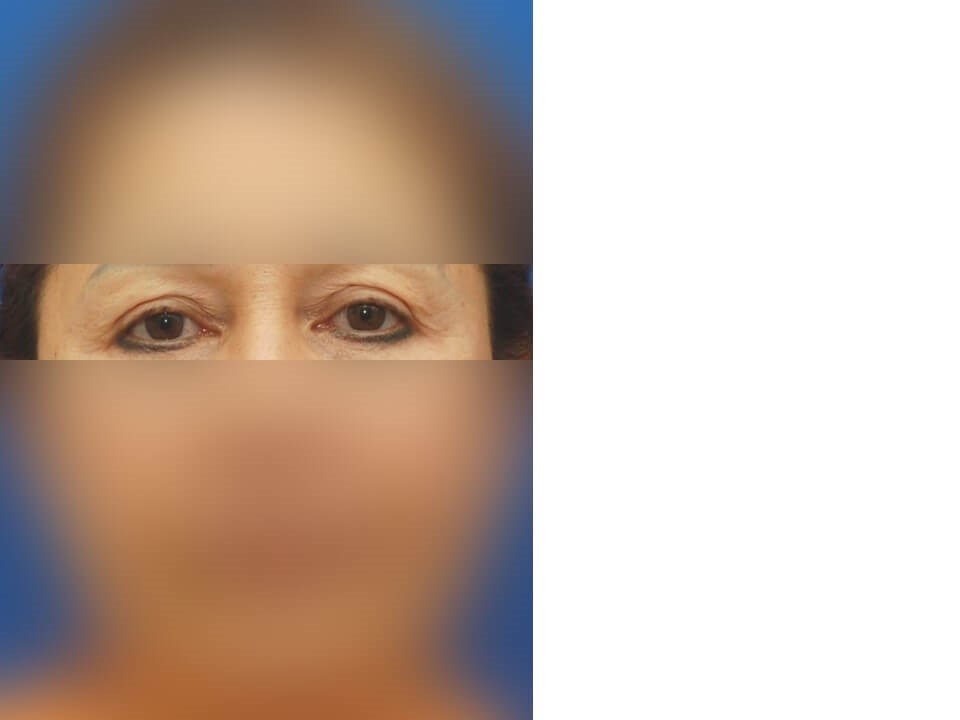 Upper Eyelid Surgery Before