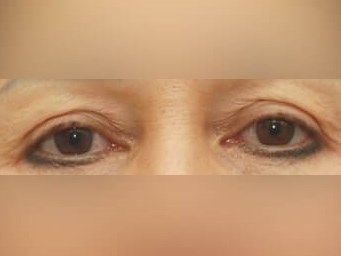 Upper Eyelid Surgery Before