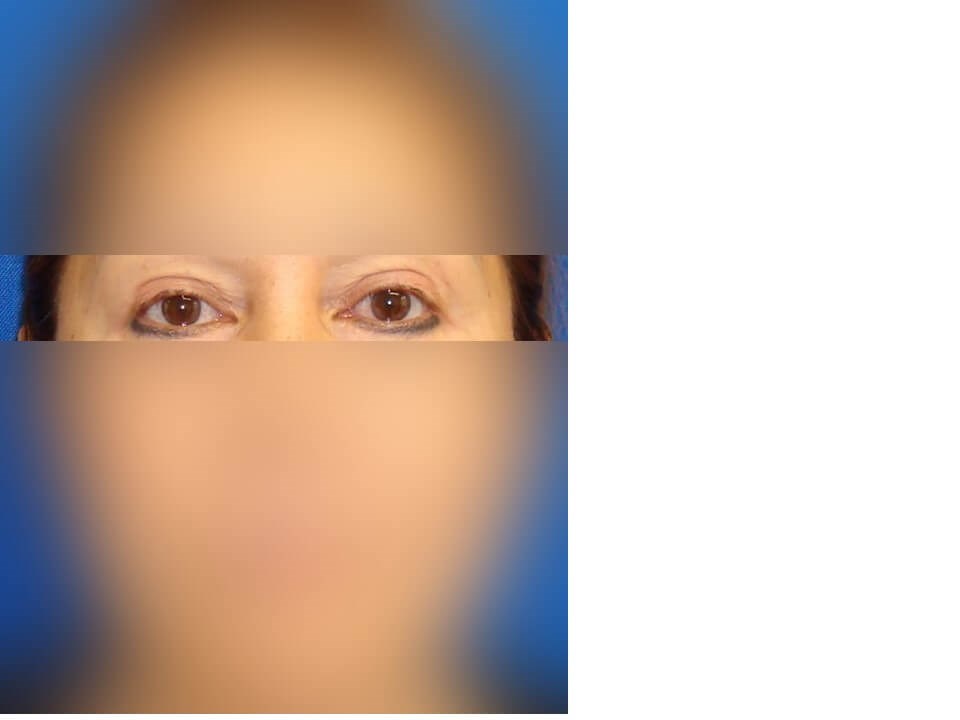 Upper Eyelid Surgery After