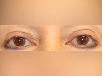 Upper Eyelid Surgery After