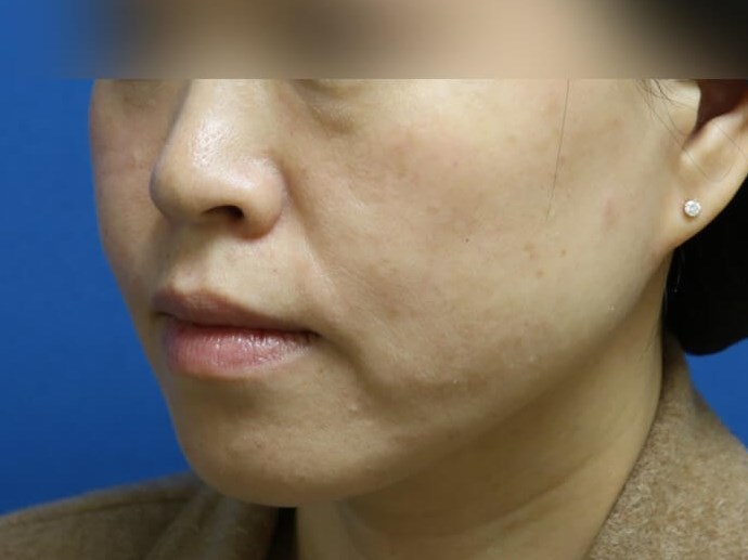 Buccal Fat Removal After