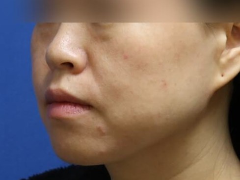 Buccal Fat Removal Before