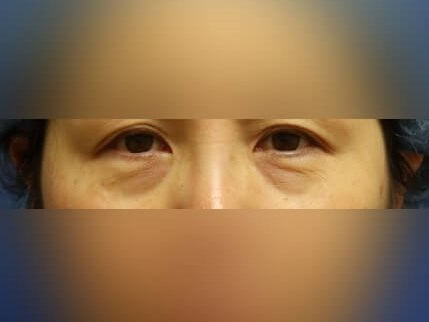 Facial Fat Graft Before