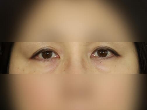 Facial Fat Graft After