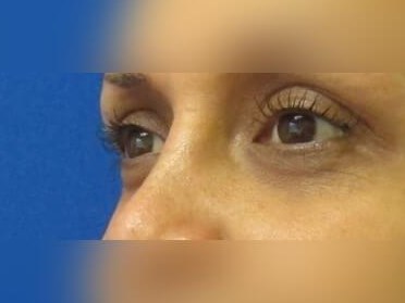 Facial Fat Graft After