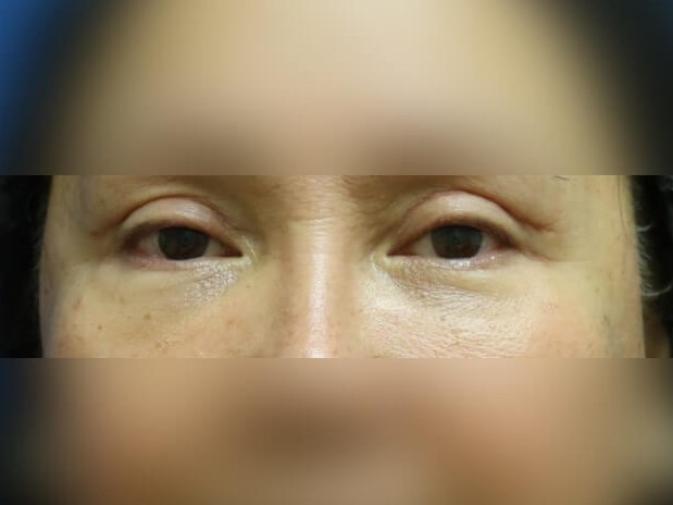Facial Fat Graft After