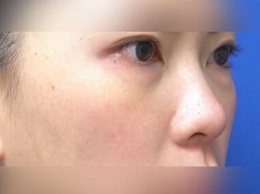Facial Fat Graft Before