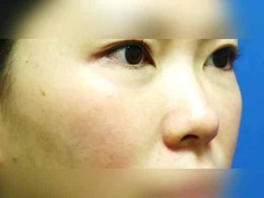 Facial Fat Graft After