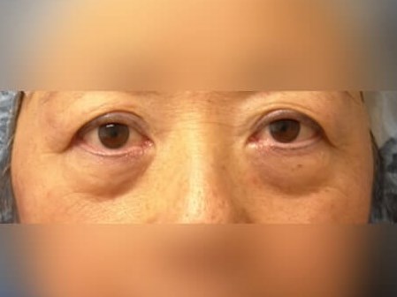 Facial Fat Graft Before