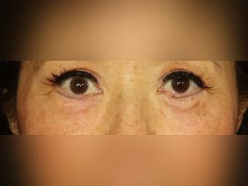 Facial Fat Graft After