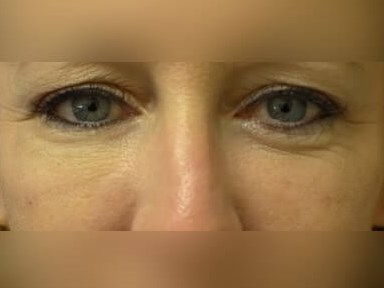 Facial Fat Graft After