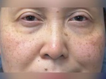 Facial Fat Graft Before