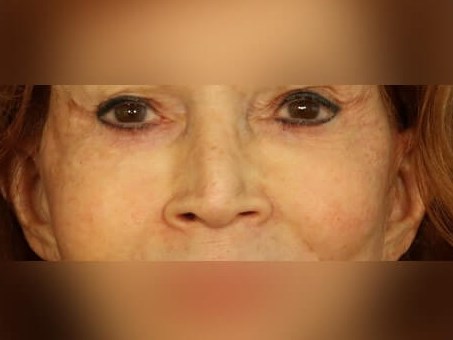 Facial Fat Graft After