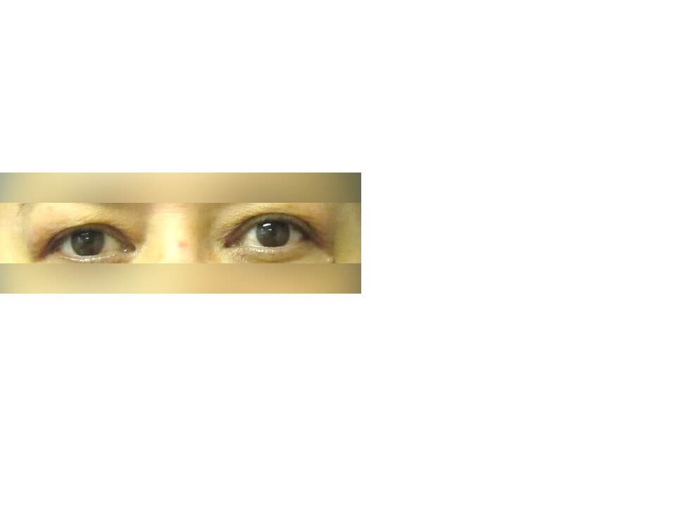 Upper Eyelid Surgery Before