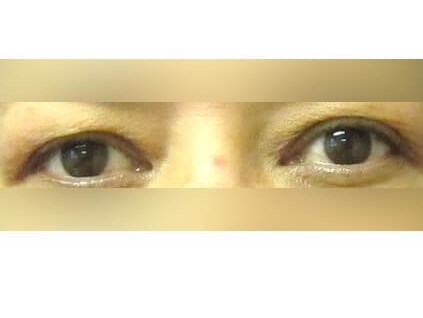 Upper Eyelid Surgery Before