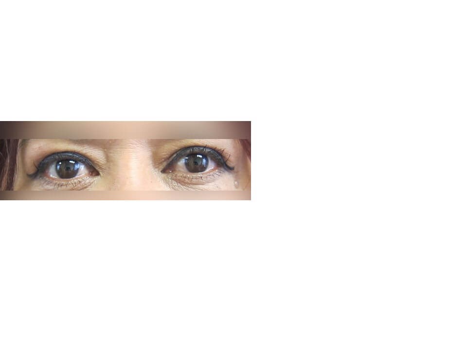 Upper Eyelid Surgery After
