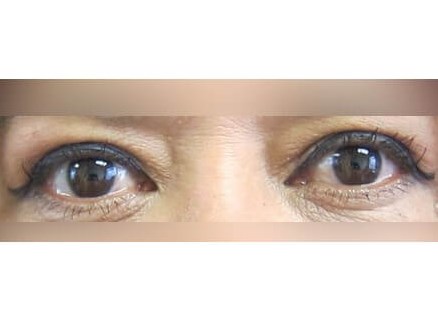 Upper Eyelid Surgery After