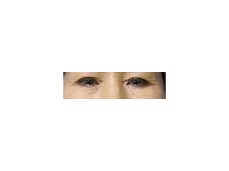 Upper Eyelid Surgery Before
