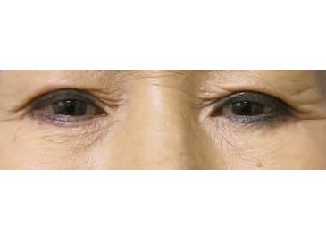 Upper Eyelid Surgery Before