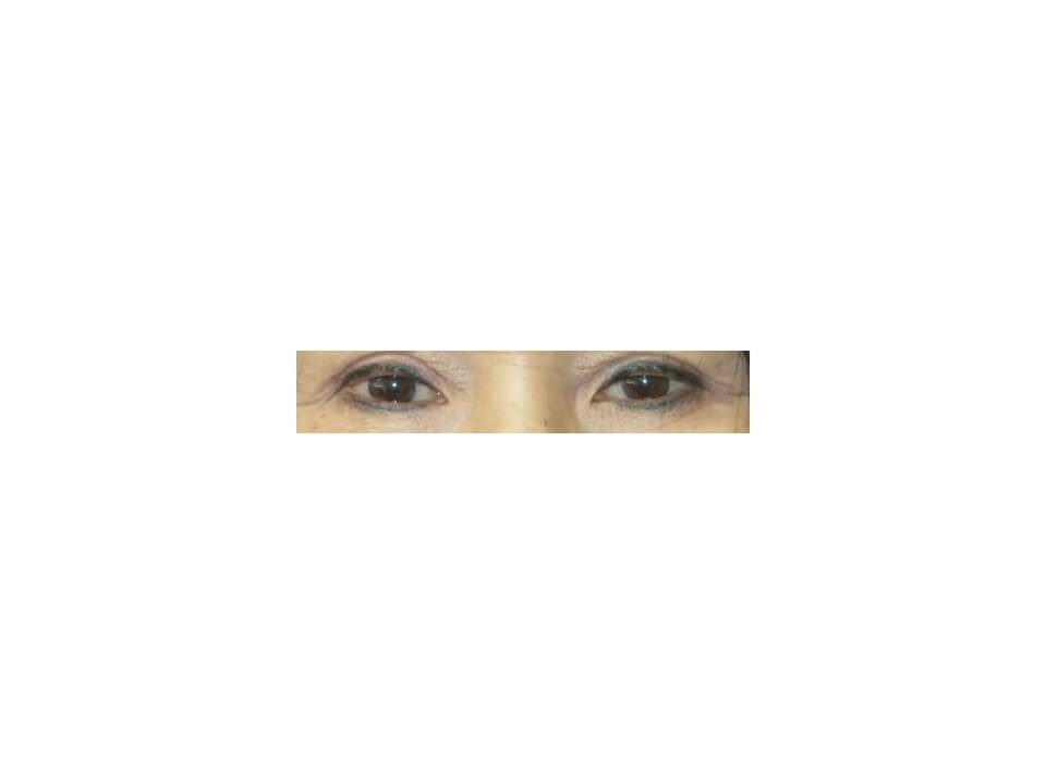 Upper Eyelid Surgery After