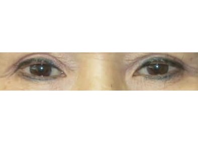 Upper Eyelid Surgery After