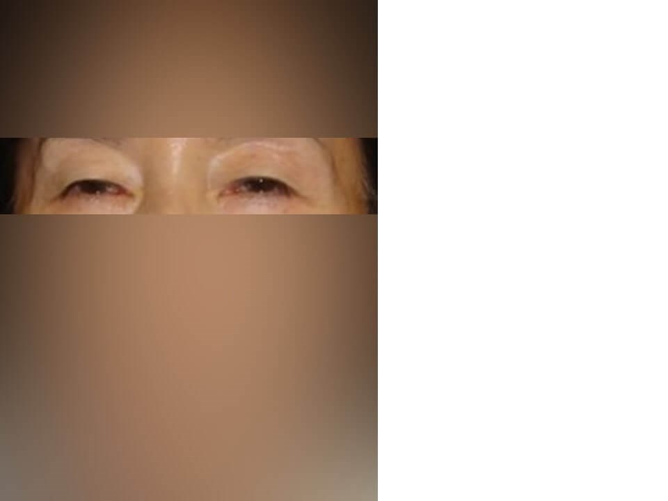 Upper Eyelid Surgery Before
