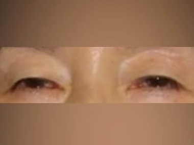 Upper Eyelid Surgery Before