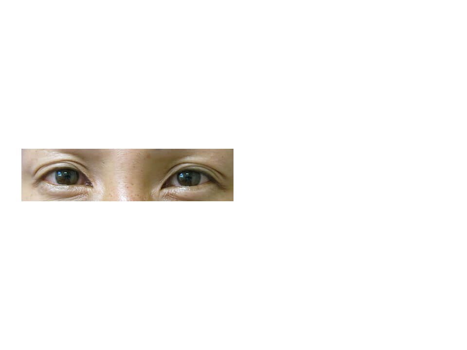 Upper Eyelid Surgery Before
