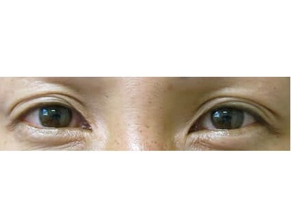 Upper Eyelid Surgery Before