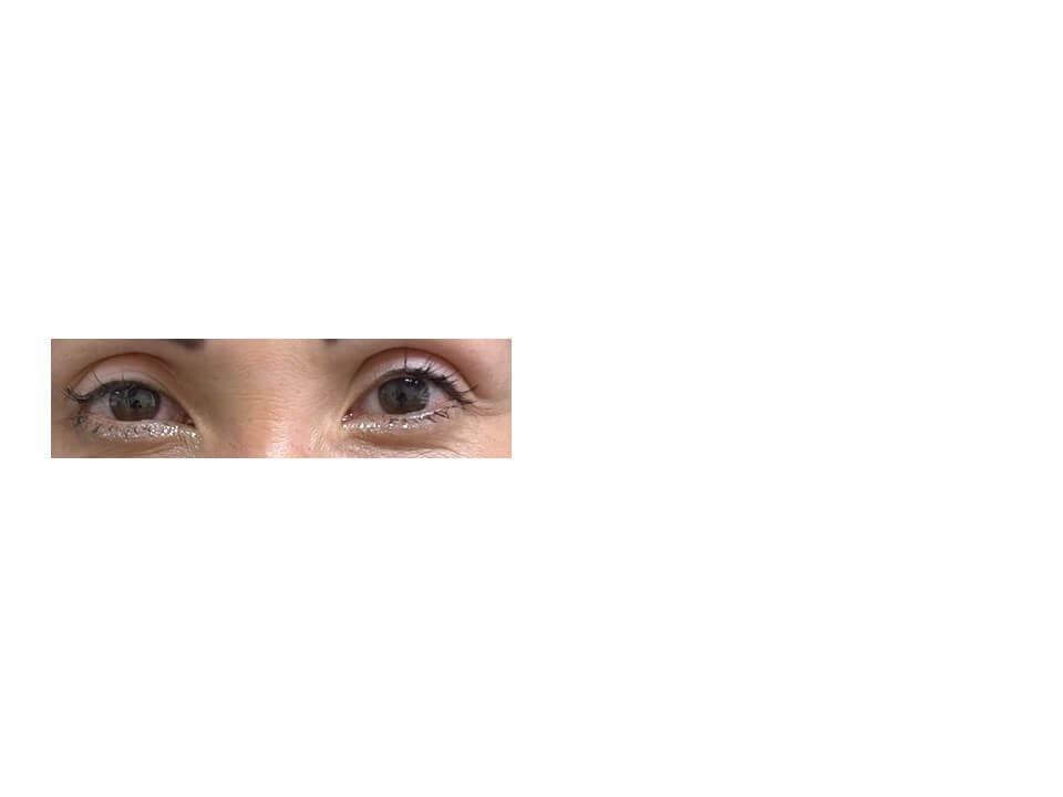Upper Eyelid Surgery After