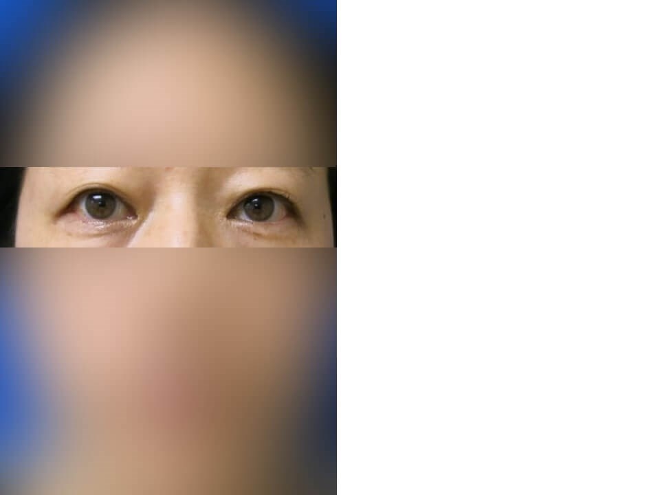 Upper Eyelid Surgery Before