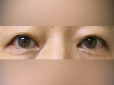 Upper Eyelid Surgery Before